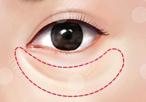 淚溝是怎么形成的？