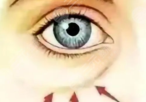 淚溝是怎么形成的？