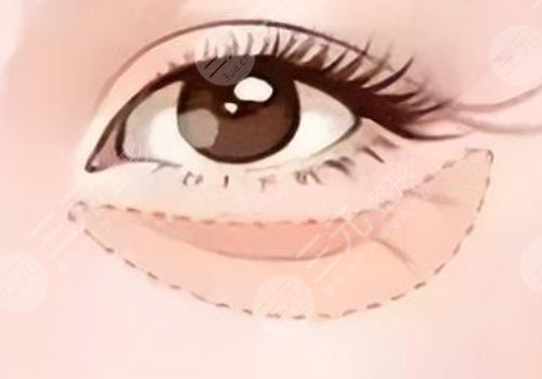 淚溝是怎么形成的？