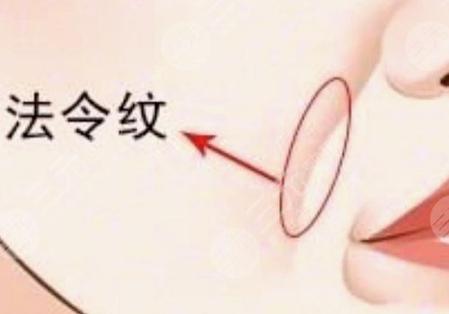 法令紋太深了有什么解決辦法？