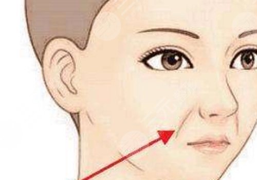 法令紋太深了有什么解決辦法？