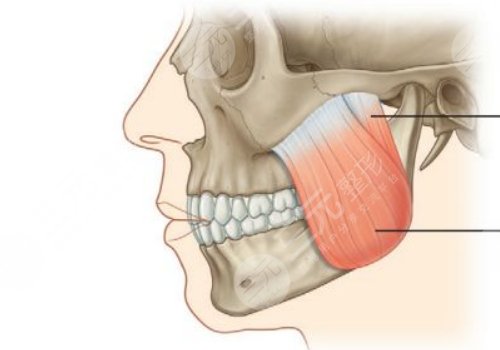 咬肌太大怎么辦如何讓咬肌變??？