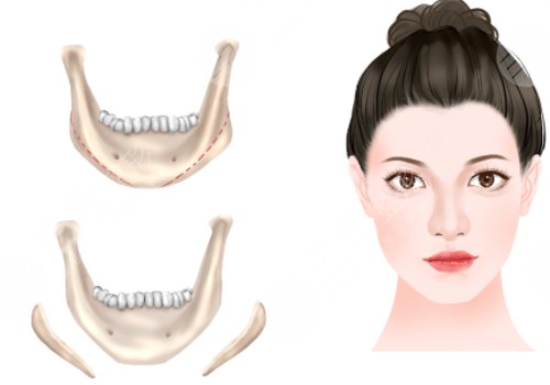 下頜角手術(shù)后頭套要戴多久？3-4周的時(shí)間？