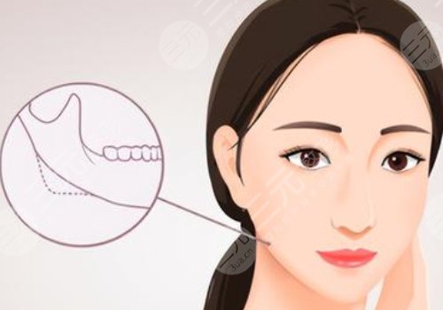 下頜角手術(shù)后頭套要戴多久？