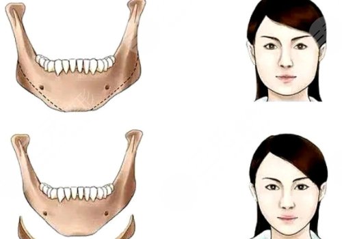 下頜角手術(shù)后頭套要戴多久？