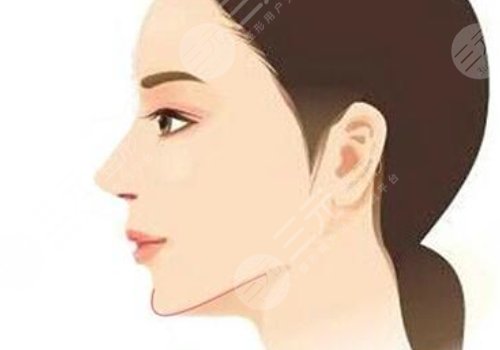 下頜角手術(shù)后頭套要戴多久？