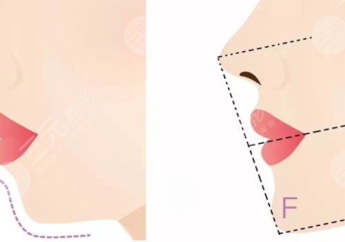 下頜緣提升怎么打？