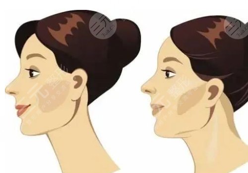 下頜緣提升怎么打？