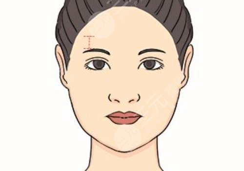 眉弓骨填充前后照片(案例)