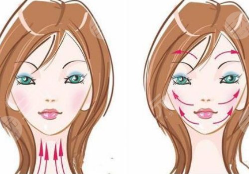 v臉繃帶提升有效果嗎？