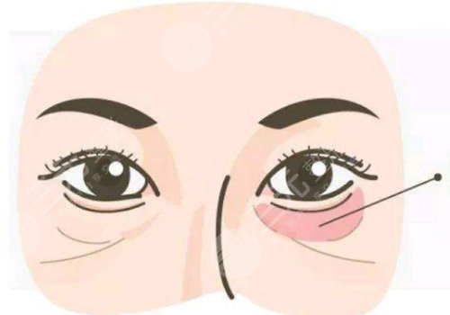 去黑眼圈和眼袋有效的方法是什么？眼周抗衰指南！