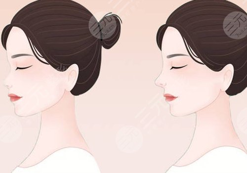 俞積貴做鼻子怎么樣？