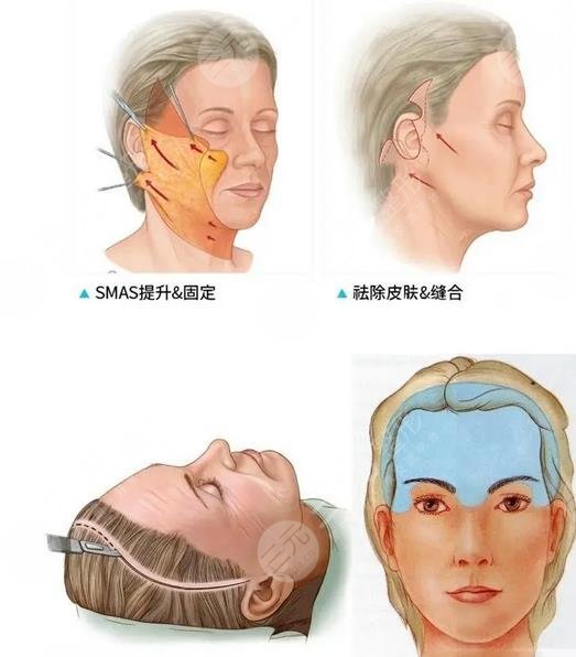 李曉東面部提升案例