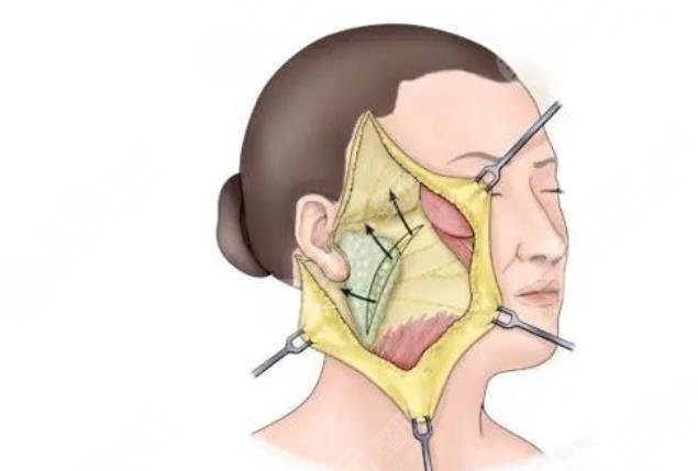 雙燕尾拉皮跟小拉皮區(qū)別