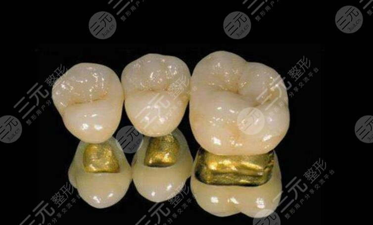 金鈀烤瓷牙價格一般是多少?