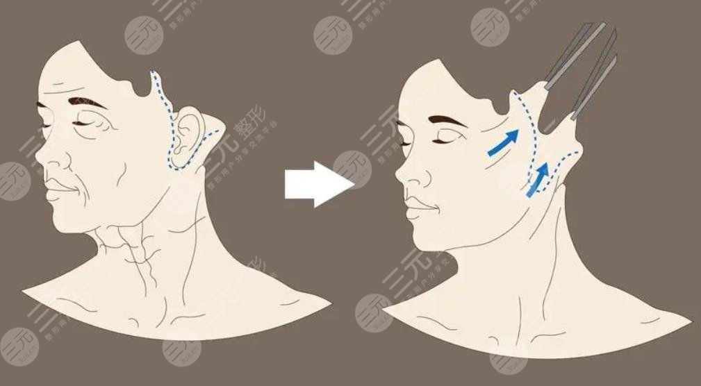 雙燕尾拉皮手術(shù)多少錢