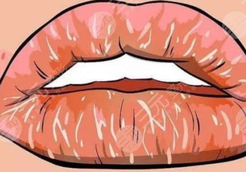 唇部老化的原因有哪些？唇部老化如何改良？