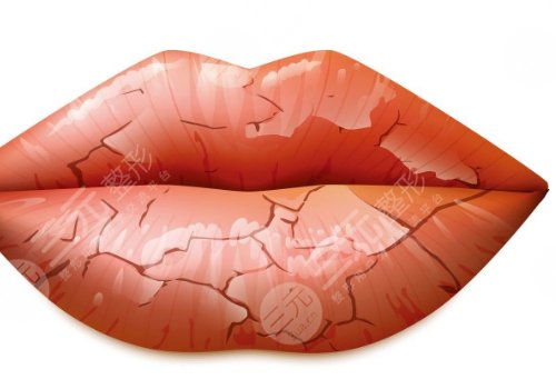唇部老化的原因有哪些？唇部老化如何改良？