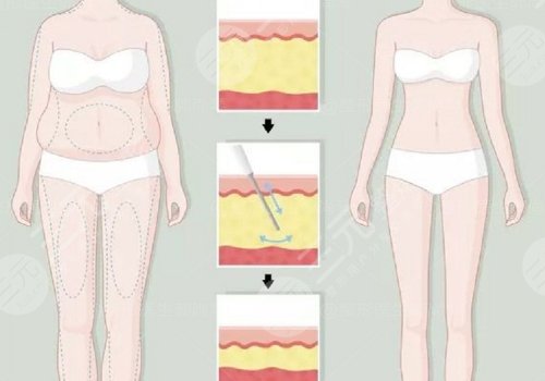 身體塑形能達(dá)到減肥的效果嗎？