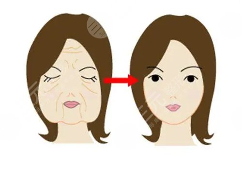 韌帶提升和拉皮的區(qū)別是什么？