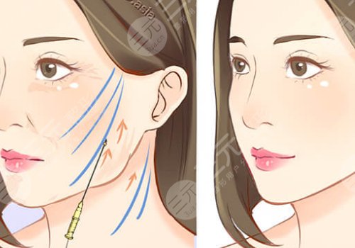 韌帶提升和拉皮的區(qū)別是什么？