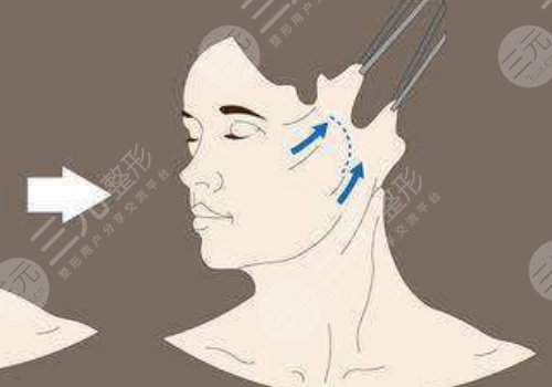 韌帶提升和拉皮的區(qū)別是什么？