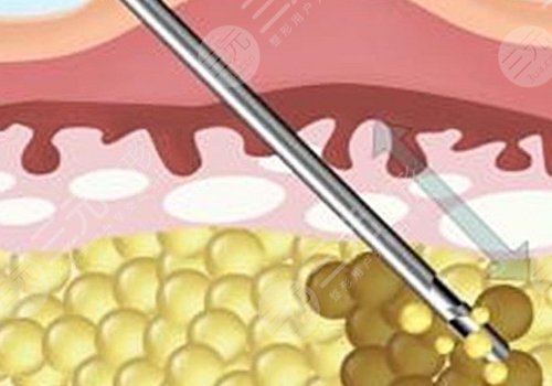 吸脂凹凸不平多久恢復？
