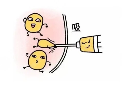 吸脂凹凸不平多久恢復？