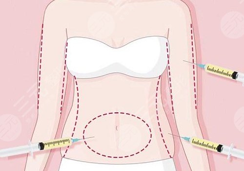 吸脂凹凸不平多久恢復？