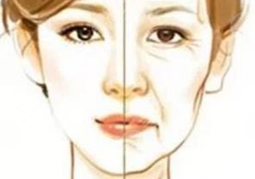 動態(tài)紋和靜態(tài)紋哪個屬于真性皺紋？