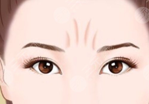 動態(tài)紋和靜態(tài)紋哪個屬于真性皺紋？