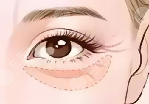 雙美膠原蛋白填充淚溝能維持多久？