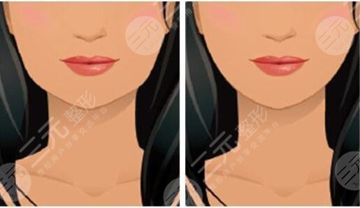 哪些人不適合做磨骨整形手術(shù)?