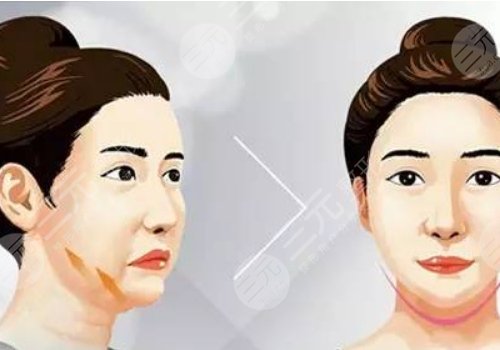 下頜緣提升有什么效果？