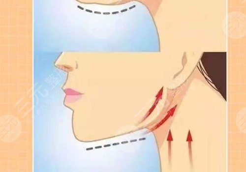 下頜緣提升有什么效果？