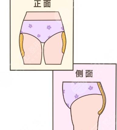 臀部?jī)蓚?cè)凸起怎么整形？吸脂體雕助你矯正不美臀型！