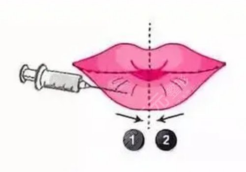 玻尿酸豐唇多久消腫？能維持多久？