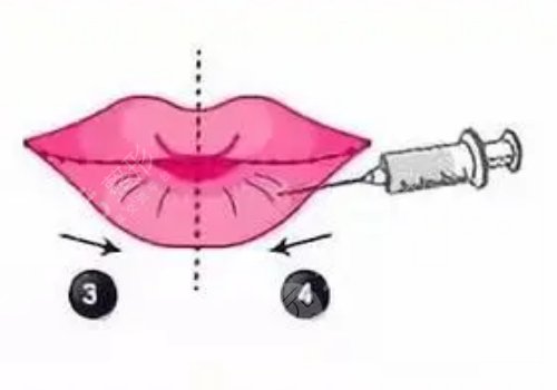 玻尿酸豐唇多久消腫？能維持多久？