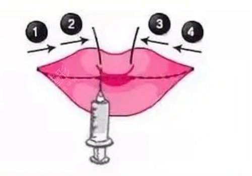 玻尿酸豐唇多久消腫？能維持多久？