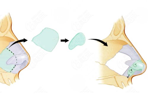 廣州市荔灣區(qū)人民醫(yī)院整形美容隆鼻怎么樣？