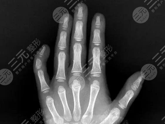 小指彎曲 手指整形 矯正