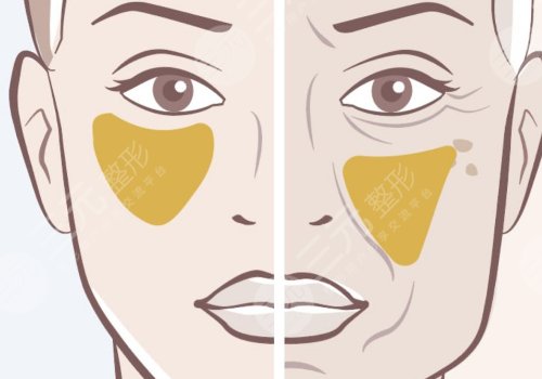 蘋果肌斷層有啥辦法解決？