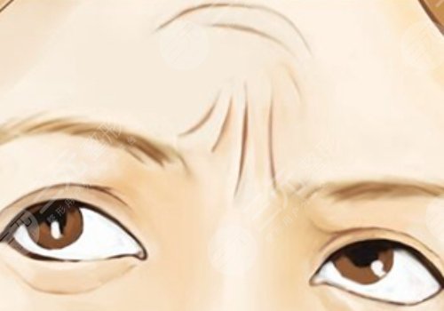 抬頭紋去除手術(shù)需要多少錢？