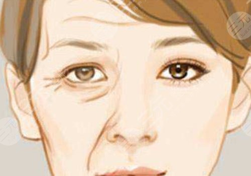 抬頭紋去除手術(shù)需要多少錢？