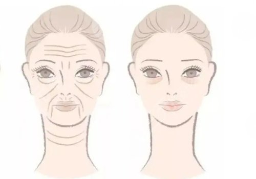 抬頭紋去除手術(shù)需要多少錢？