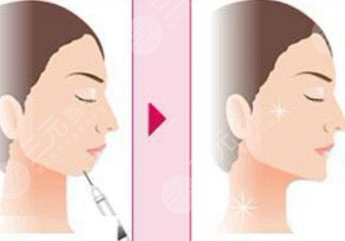 玻尿酸填充下巴有什么副作用？