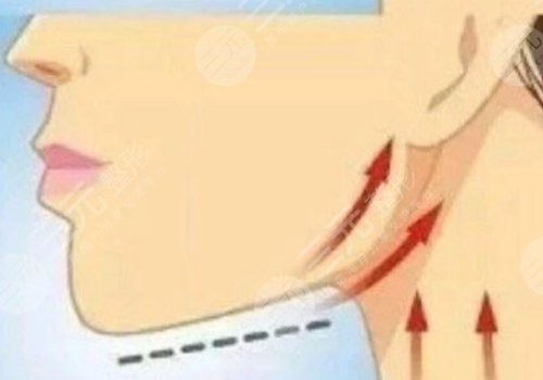 下頜線提升前后對比圖