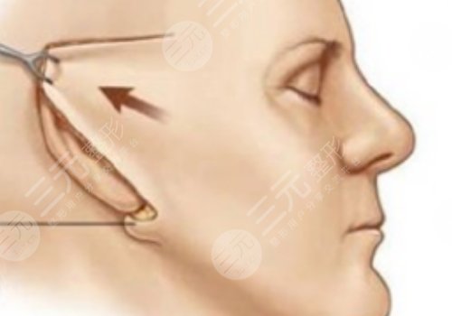 筋膜懸吊術(shù)適合多大年齡的？