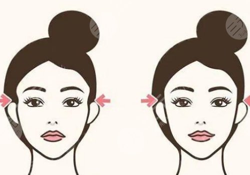 膠原蛋白填充太陽(yáng)凹大概多少錢？