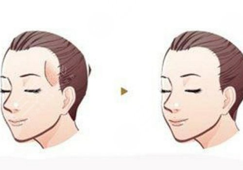 膠原蛋白填充太陽(yáng)凹大概多少錢？